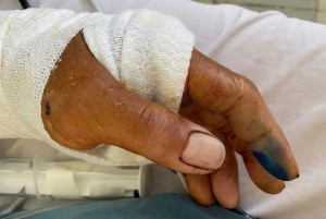 Cứu sống bệnh nhân bị đứt động mạch cánh tay trái