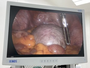Phẫu thuật nội soi cấp cứu bóc khối u nang buồng trứng xoắn